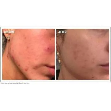 Glowbiotics Probiotic Acne Cleanser: Gentle Foaming Face Wash for Acne-Prone Skin | Clears Pores, Removes Dirt & Oil, Soothes Redness with Salicylic Acid & Niacinamide