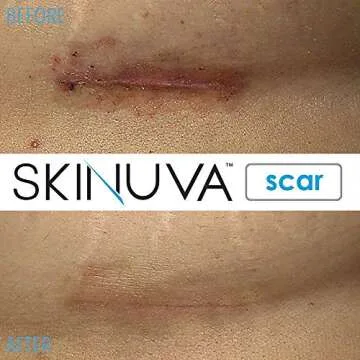 Skinuva® Next Generation Scar Cream - Advanced Scar Silicone Cream Matrix Formulated with Growth Factors (1.7 oz)