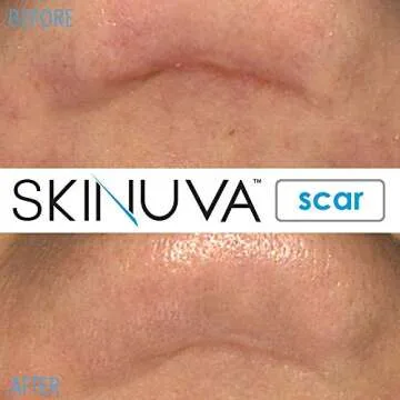Skinuva® Next Generation Scar Cream - Advanced Scar Silicone Cream Matrix Formulated with Growth Factors (1.7 oz)