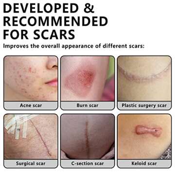 Pallesen Silicone Scar Sheets for Safe Scar Treatment