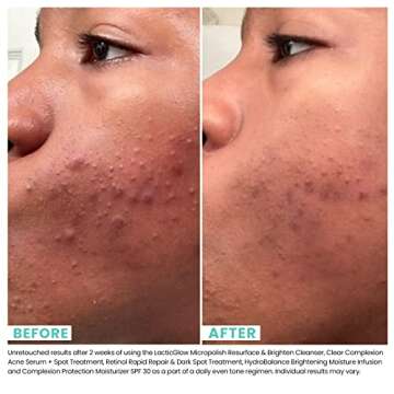 Urban Skin Rx Clear Complexion Acne Serum + Spot Treatment | Helps to Reduce + Prevent Breakouts, Improves the Look of Blemishes and Aging Skin with 5% Benzoyl Peroxide and 5% Glycolic Acid | 1 Fl Oz