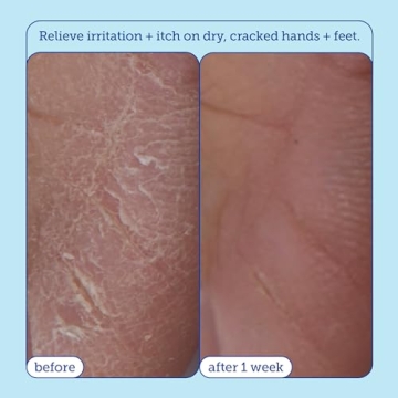 Skinfix Eczema+ Hydrating Hand Repair Cream 3 FL Oz