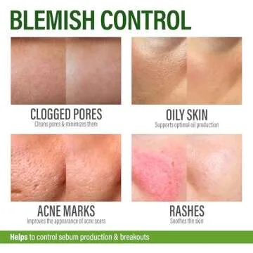 Acne Supplements for Clear Skin with Biotin, Zinc, Vitamin A & Niacin - Acne Pills for Acne Scar Treatment - Cystic Acne Treatment with Probiotics for Gut Health & Glowing Skin - Made in USA - 60 Caps