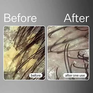 ACT+ ACRE Cold Processed Balancing Shampoo - Clarifying Cleanse for Build Up - Sulfate Free Gentle Hair Treatment with Moringa Oil - Moisturize and Strengthen Damaged Hair (10 Fl.oz)