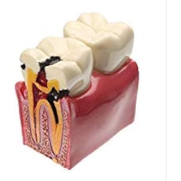 YOUYA Dental Caries Tooth Model - 6 Times Caries Teaching Tool