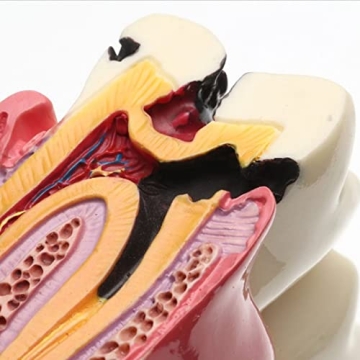 Dental Caries Tooth Model for Effective Dental Education