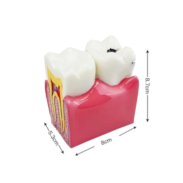 Dental Caries Tooth Model for Effective Dental Education