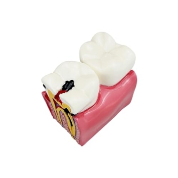 Dental Caries Tooth Model for Effective Dental Education