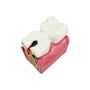 Dental Caries Tooth Model for Effective Dental Education
