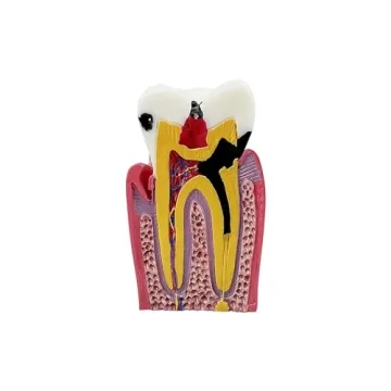 Dental Caries Tooth Model for Effective Dental Education
