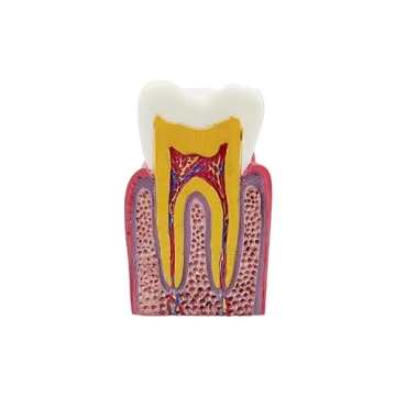Dental Caries Tooth Model for Effective Dental Education