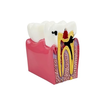 Dental Caries Tooth Model for Effective Dental Education