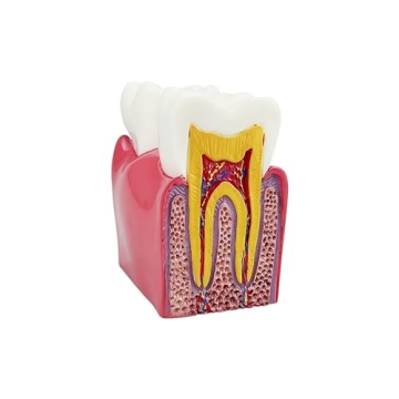 Dental Caries Tooth Model for Effective Dental Education