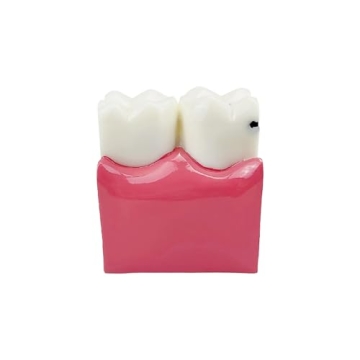 Dental Caries Tooth Model for Effective Dental Education