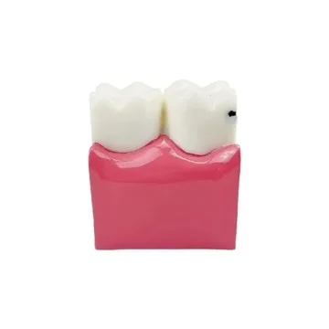 Dental Caries Tooth Model for Effective Dental Education