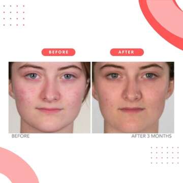 Serious Skincare Dry Lo Overnight Acne Spot Treatment for Face - Blemish Drying Lotion with Sulfur & Salicylic Acid - Helps Clear Skin and Prevent Break Outs - Clogged Pores - Blackheads - 1 oz.