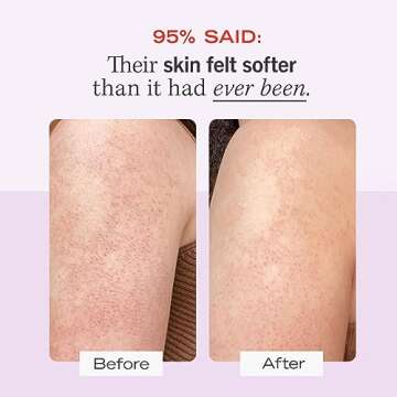 First Aid Beauty - KP Bump Eraser Body Scrub with 10% AHA, Keratosis Pilaris Skin Exfoliater with Glycolic and Lactic acids, Helps Reduce Chicken Skin Bumps, Safe for Sensitive Skin, 4 oz