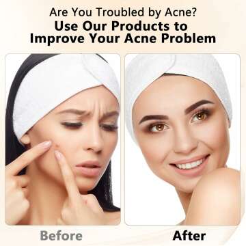 Blackhead Remover Tool Kit - 2 Stainless Steel Tools