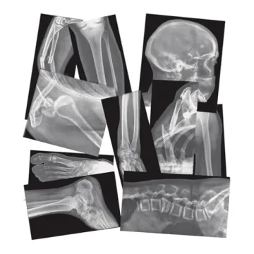 Roylco Broken Bones X-Rays – 15 Realistic Fracture Images for STEM/STEAM Learning, Classroom Anato...