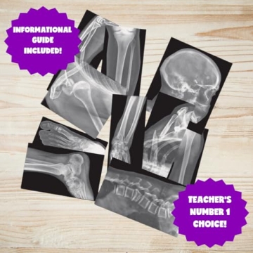Roylco X-Rays – Realistic Fracture Images for Learning
