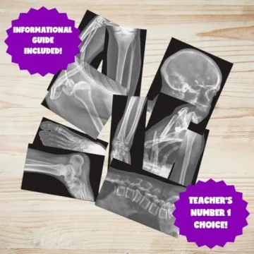 Roylco X-Rays – Realistic Fracture Images for Learning