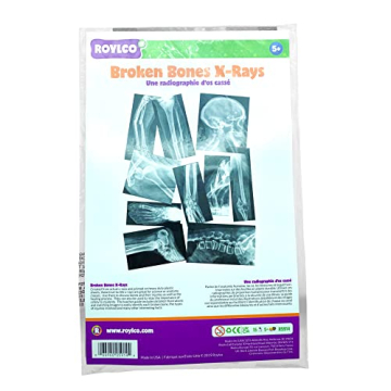 Roylco X-Rays – Realistic Fracture Images for Learning