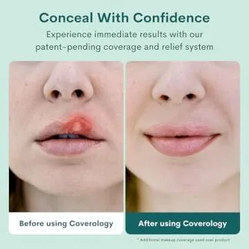 Coverology Cold Sore Treatment & Cold Sore Concealer - Lightweight Treatment & the Best Full Coverage Cold Sore Cover Up Makeup to Help Disguise and Soothe - Light