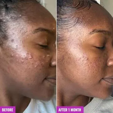 Good Molecules Acne Foaming Cleanser - Foam Anti-Acne Face Wash with Salicylic Acid BHA for Breakouts - Skincare for Face with Aloe and Witch Hazel