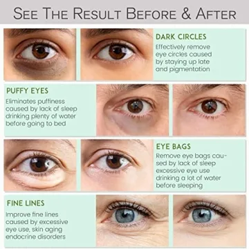 NAZANO Under Eye Patches for Dark Circles and Puffiness