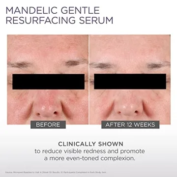 Gentle AHA Serum for Radiant Redness-Prone Skin