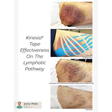 Kinesio Classic Edema Strips 12 Pack for Muscle Relief