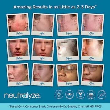 Neutralyze Exfoliating Acne Treatment Pads - 100 Dual Textured Acne Face Wipes with 2% Salicylic Acid & 2% Mandelic Acid - Toner Pads for Acne Prone Skin, Face & Body Acne Wipes for Teens & Adults