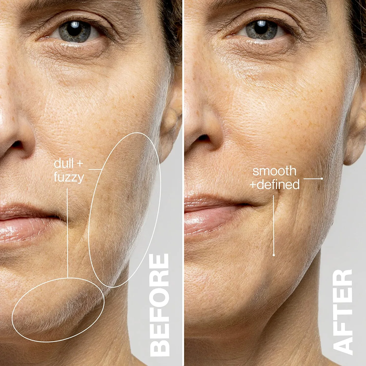 DERMAFLASH LUXE+ - Exfoliation & Hair Removal Device