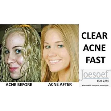 JOESOEF SKIN CARE Sulfur Soap for Acne Pharmaceutical Grade Dermatologists Approved for Acne Rosacea...