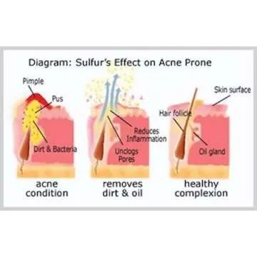 JOESOEF Sulfur Soap for Acne Treatment Dermatologist Approved