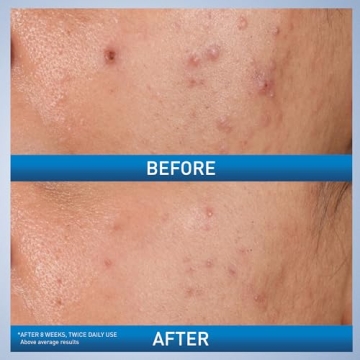 CeraVe Acne Control Gel for Clearer Skin and Gentle Care