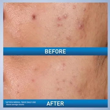 CeraVe Acne Control Gel for Clearer Skin and Gentle Care