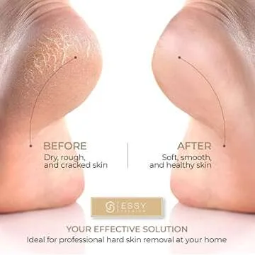 Essy Electric Foot Callus Remover for Silky Smooth Feet