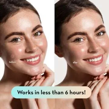 LE GUSHE Korean Pimple Patches for Face (132 Dots) - Hydrocolloid Acne Patches with Tea Tree Oil - Invisible Zit Stickers - Dermatologist Tested - Korean Skin Care