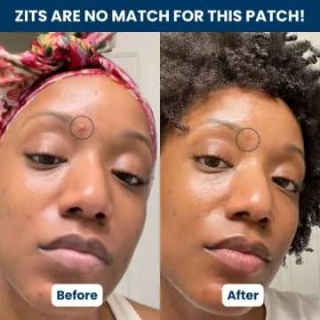 Clean Skin Club 60 Invisible Vegan Pimple Patches, Derma Dot Hydrocolloid for Covering Zits, Blackhead, Blemish, Absorbing Face Cover Sticker, Skincare Treatment, Non Toxic Ingredients