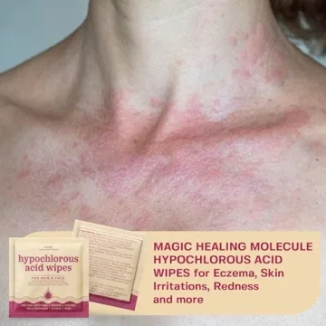 Hypochlorous Acid Wipes for Skin Piercing Acne Eczema Care