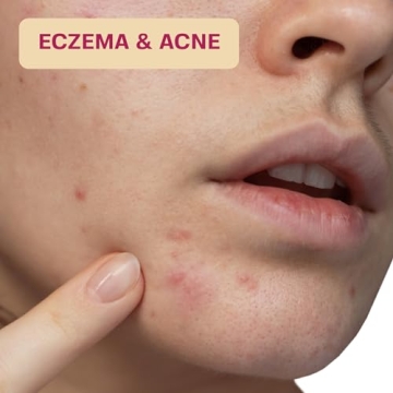Hypochlorous Acid Wipes for Skin Piercing Acne Eczema Care