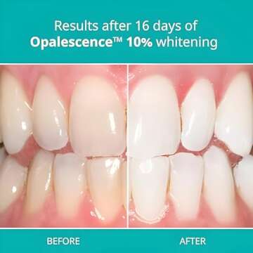Opalescence 10% Teeth Whitening Kit - Easy and Effective