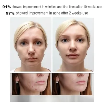 Avorla Beauty LED Mask for Wrinkles and Acne Treatment