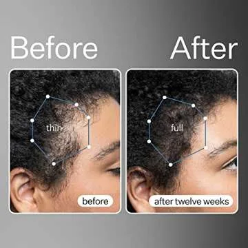 Act+Acre Cold Processed Stem Cell Scalp Serum and BHA Salicylic Acid Scalp Exfoliator Bundle - Promotes Thicker and Fuller-Looking Hair - Soothes and Hydrates - Dry Itchy Scalp - Dry Scalp -Oily Hair