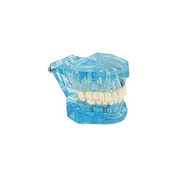 YOUYA Transparent Dental Implant Teeth Model for Dentists