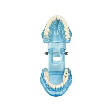 YOUYA Transparent Dental Implant Teeth Model for Dentists