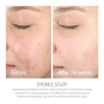 Epionce Renewal Lite Facial Lotion - Lightweight Hydrating, Anti-Aging Moisturizer for Combination to Oily & Problem Skin, Dermatologist Skincare