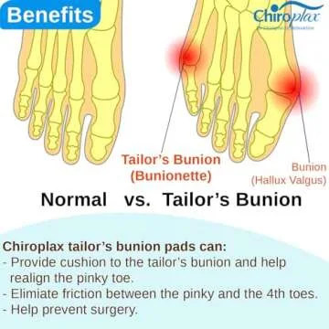 Chiroplax Tailor's Bunion Corrector Pads Bunionette Pain Relief Pinky Little Toe Straightener Separator Cushion Splint Protector Shield Spacer Cover Guard (4 Pads, Shims -Small)