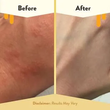 Natural Eczema Honey Oatmeal Body Lotion | 16 Oz